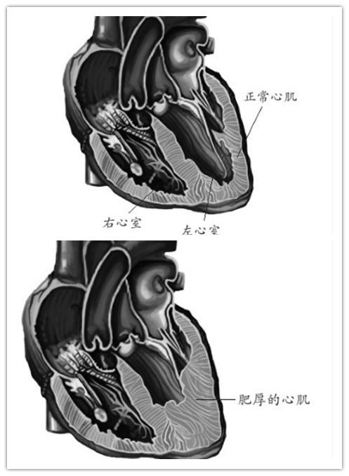 心脏扩大了现在又不大了,心脏增大不管它会怎样