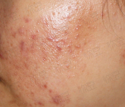 班赛祛痘吗,用班赛会爆痘吗