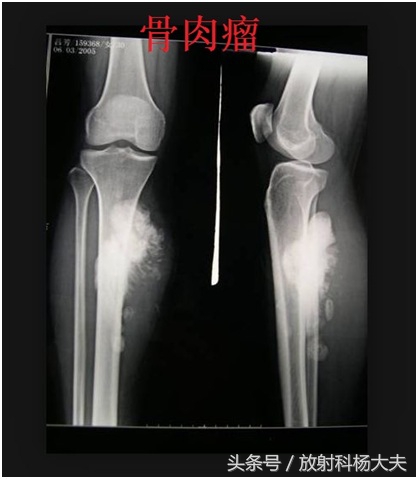 骨肉瘤是罕见病,和骨肉瘤相似的病