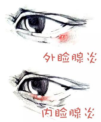 眼皮起麦粒肿什么病引起的,右眼长了麦粒肿有什么征兆