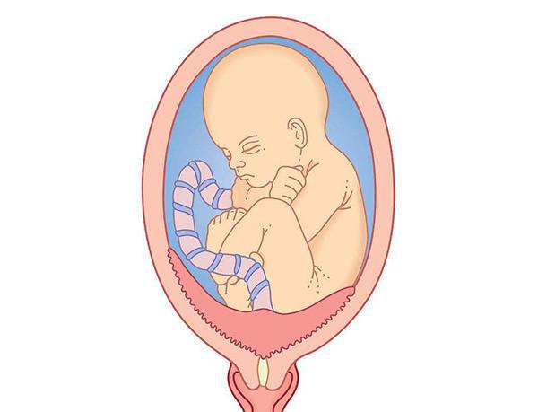 孕早期胎盘前置怎么办,孕中期前置胎盘孕妇关注事项