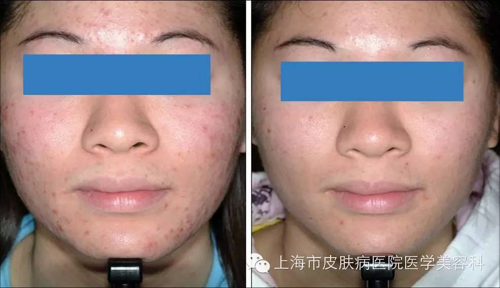 战痘神器110块,战痘神器祛痘效果怎么样