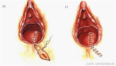 生产时，自然撕裂和侧切有什么不同？哪个恢复更快，该如何选择？