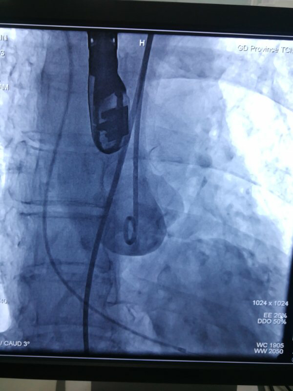 心脏阀门关不严怎么治疗,心脏阀门关不严手术费用