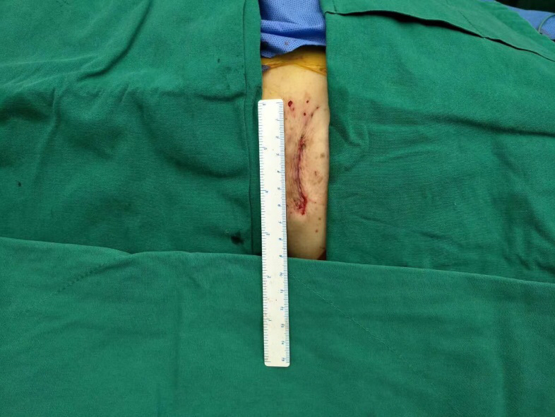 心脏阀门关不严怎么治疗,心脏阀门关不严手术费用