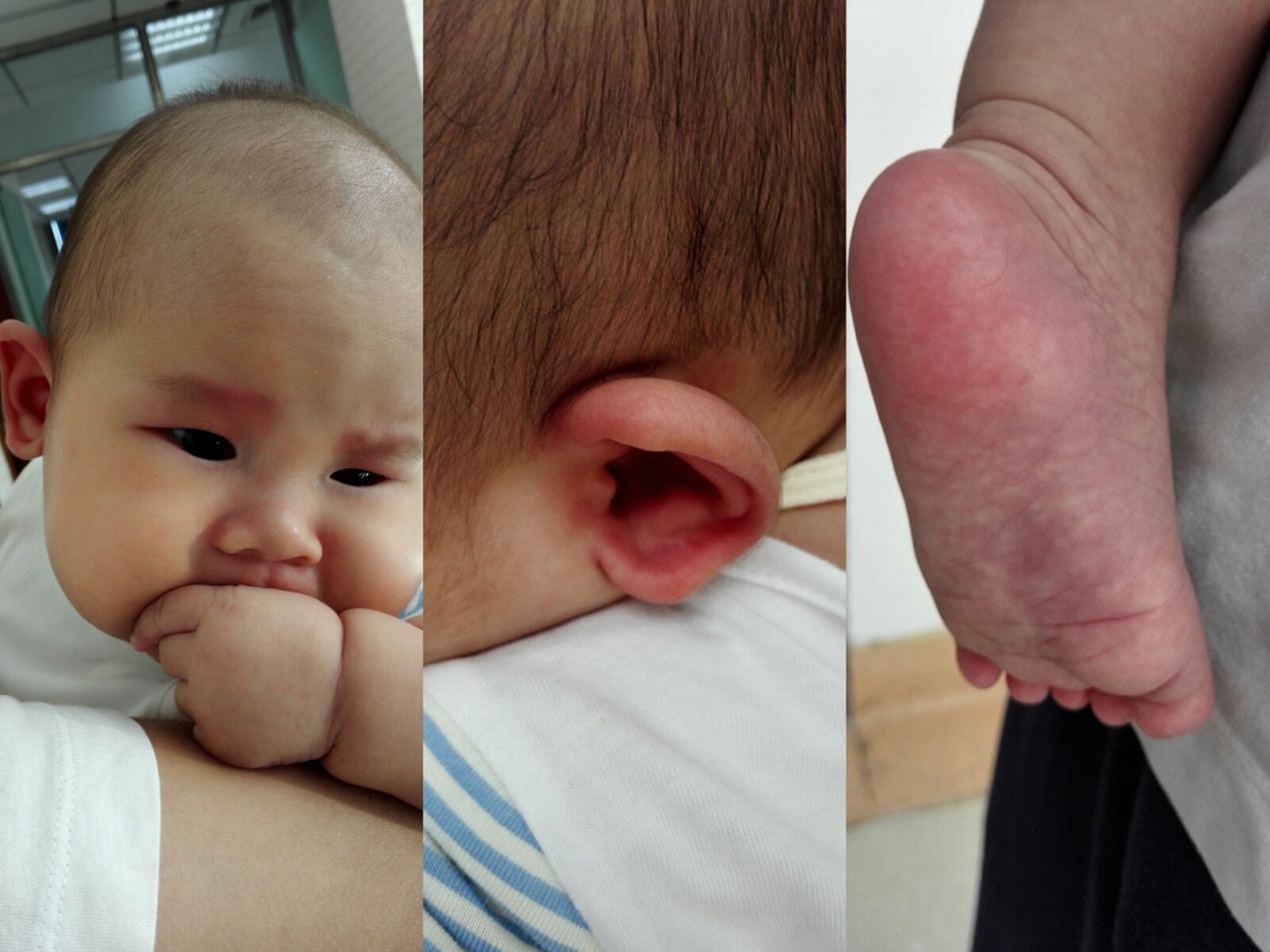 宝宝打疫苗过敏了怎么解决,婴儿打完疫苗过敏怎么办