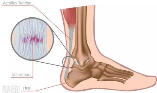 跟腱断裂mr诊断模板,美国跟腱断裂修复手术