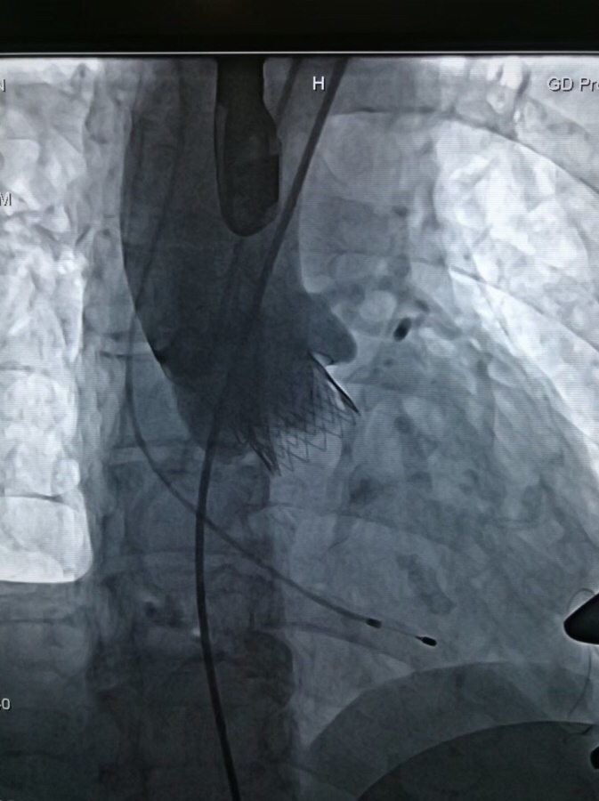 心脏阀门关不严怎么治疗,心脏阀门关不严手术费用