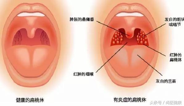 扁桃体反复发作有必要割掉吗,扁桃体一年发作一次需要切除么