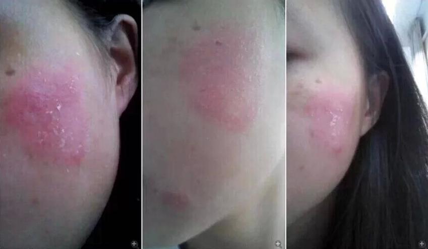 一敷面膜就长痘痘怎么办,敷面膜长痘用什么祛除