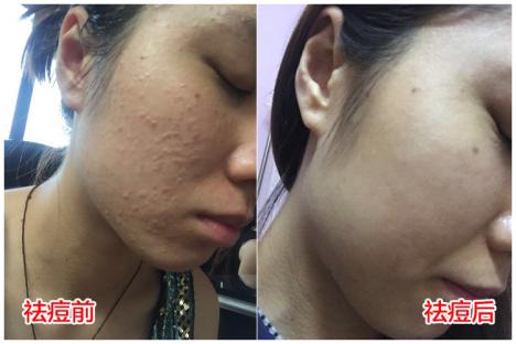 祛除痘印最有效的祛痘神器,祛痘神奇小妙招