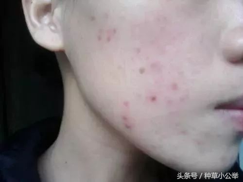 手贱抠痘后抹什么药,手贱挤痘了怎么办