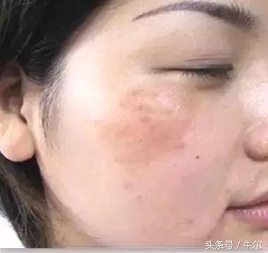 激光祛斑能祛遗传斑吗,祛斑祛黑色素最有效的方法