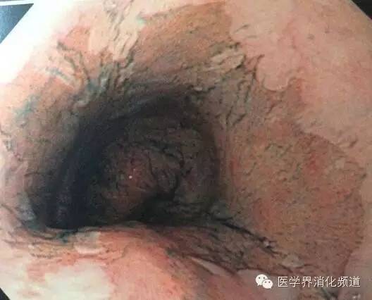 barrett食管的症状是什么,barrett食管症状可怕吗