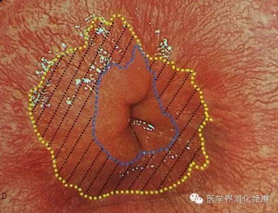 barrett食管的症状是什么,barrett食管症状可怕吗