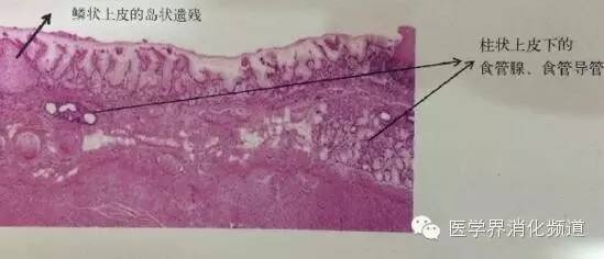 barrett食管的症状是什么,barrett食管症状可怕吗