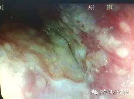 barrett食管的症状是什么,barrett食管症状可怕吗