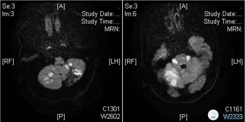 颅内动脉狭窄介入治疗研究,颅内血管cta副作用
