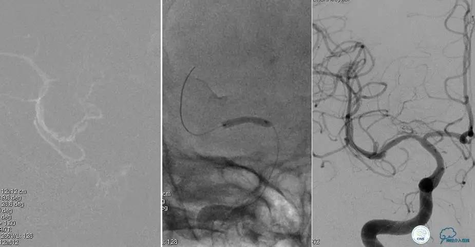 颅内动脉狭窄介入治疗研究,颅内血管cta副作用