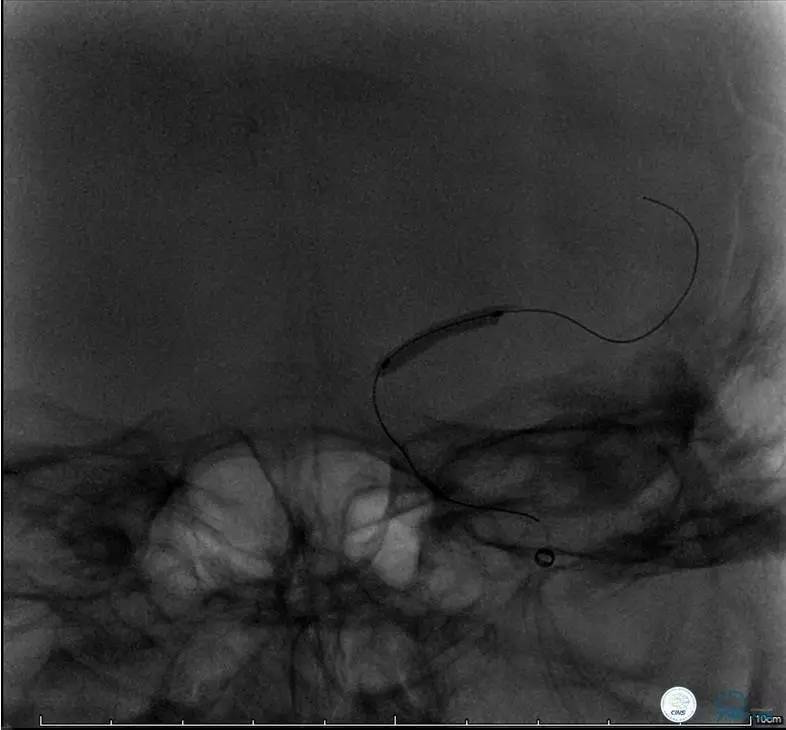 颅内动脉狭窄介入治疗研究,颅内血管cta副作用
