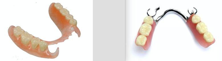 先天性缺牙原因及治疗,缺牙怎么办需要根管治疗吗