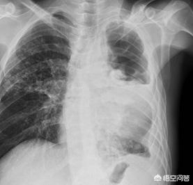 为什么从来没有感染过结核，也会出现结核菌素阳性