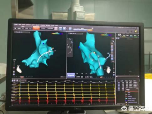 室上速对孩子遗传有影响吗,室上速发作会影响心脏吗