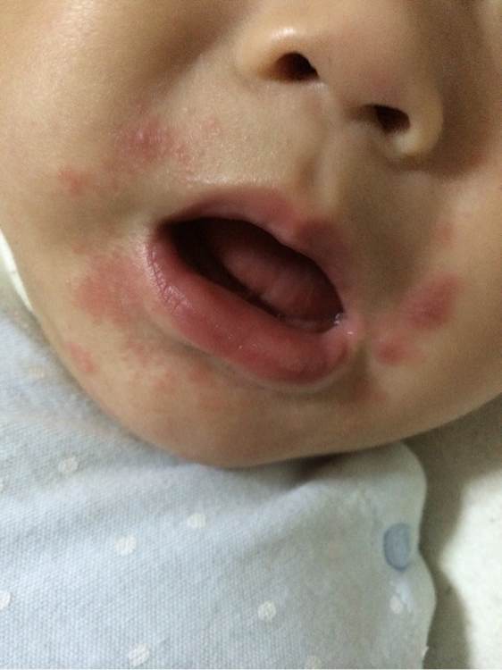 6个月宝宝嘴边眼睛周围有湿疹,6个月的宝宝嘴边起湿疹怎么办