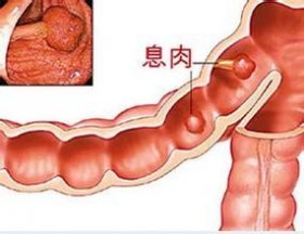 结肠息肉内镜下切除,结肠息肉内镜下切除关注护理