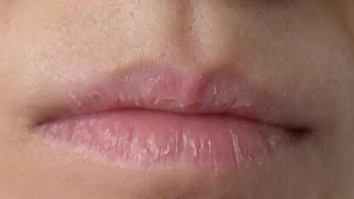 别让口腔难闻问题毁了你的颜值,别让你干裂的嘴影响你