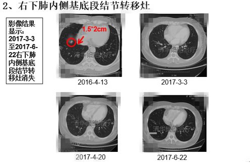 肺鳞癌能用nk细胞疗法吗,肺腺癌nkt治疗成功案例