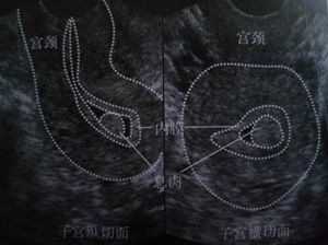 子宫内膜息肉手术影响经期吗,子宫内膜息肉宫腔镜手术时间