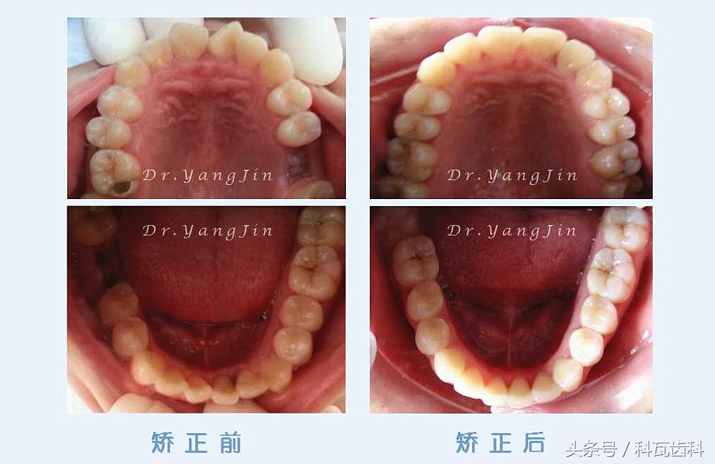 青少年适合种植牙还是假牙,缺牙活动假牙修复