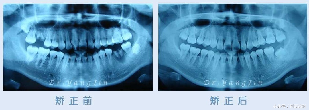 青少年适合种植牙还是假牙,缺牙活动假牙修复
