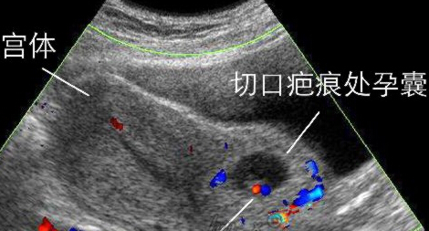孕期出血是宫颈有问题吗,孕期流血一定是流产吗