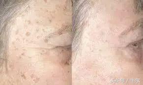 激光祛斑能祛遗传斑吗,祛斑祛黑色素最有效的方法