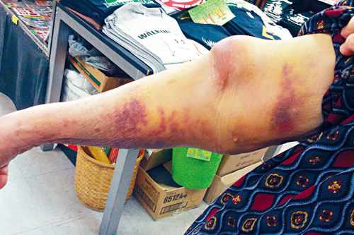 抽血抽到手麻护士,抽血护士把你手抽淤青怎么办