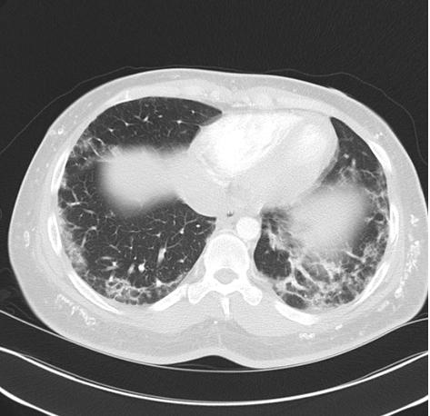 多发性肌炎和皮肌炎的首选药物是,皮肌炎与多发性肌炎的病因介绍