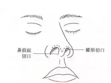 「爱美」双眼之间“一片荒芜”，鼻子一塌毁所有啊！