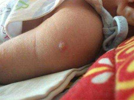 宝宝手臂内侧化脓怎么处理,孩子外伤感染化脓怎么处理