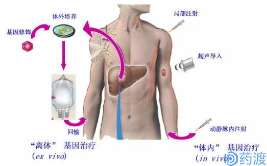 二型糖尿病基因疗法,基因疗法再生视神经