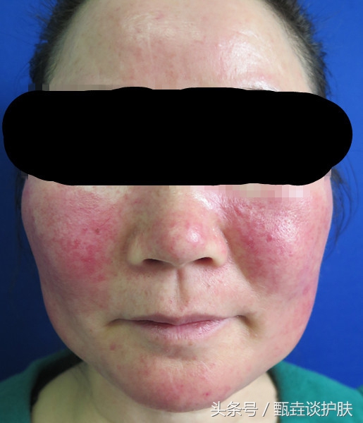 皮肤敏感红血丝怎么修复,红血丝严重敏感肌肤适合什么治疗