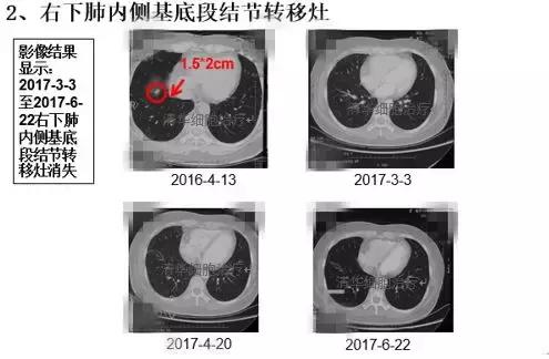 肺腺癌晚期nkt细胞免疫治疗价格,肺癌晚期nk细胞疗法