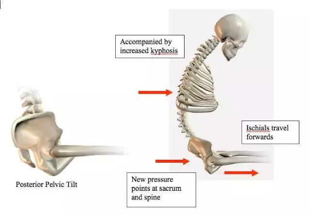 骨盆后倾的自我矫正方法,骨盆后倾怎样自己矫正