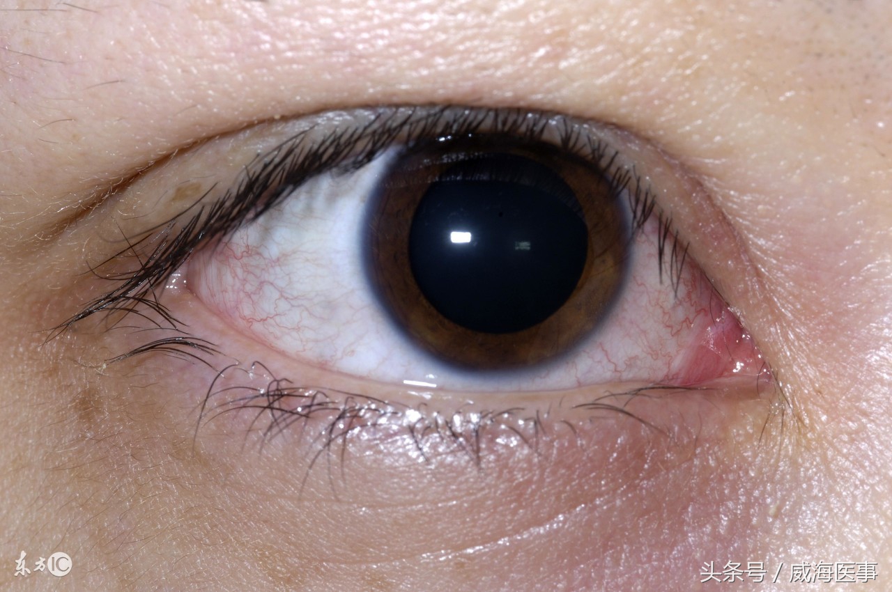 飞蚊症到底会不会导致失明,老年人飞蚊症能引起失明吗