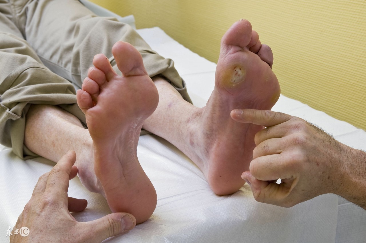 糖尿病足一级溃烂最佳治疗方法,中医治疗糖尿病足溃烂用什么药