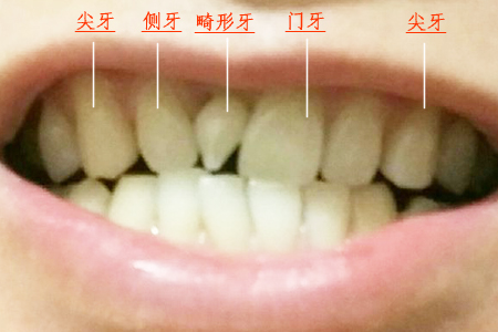 碰到牙了怎么处理,门牙旁边的牙尖小怎么办