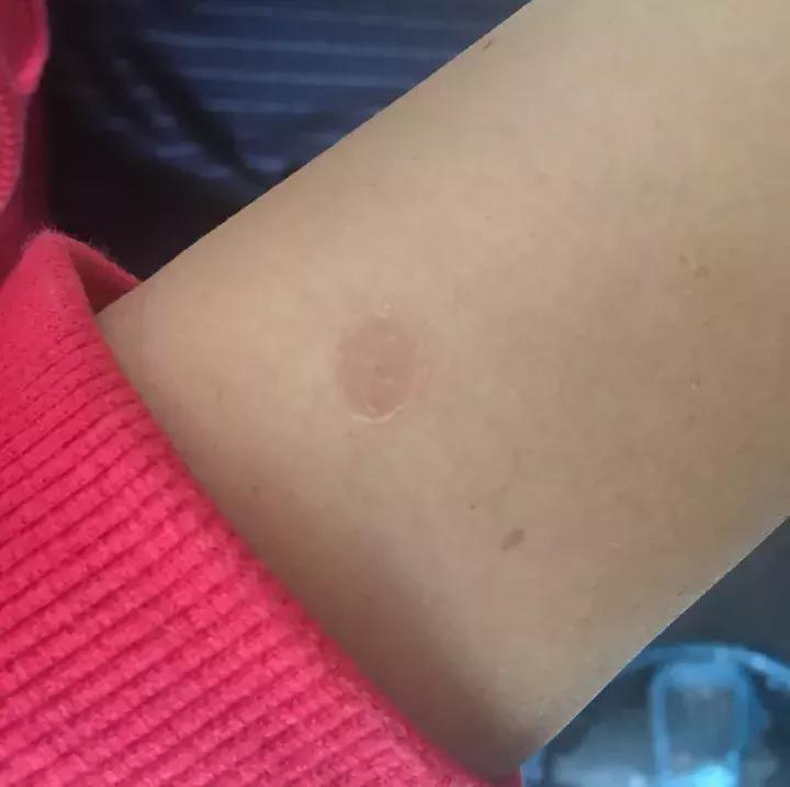 治疗猫癣过程关注什么,猫咪预防猫癣用什么药比较好