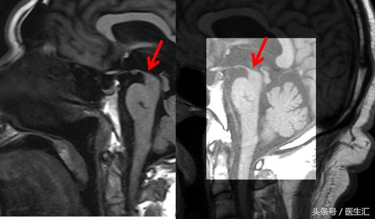 进行性核上性麻痹综合征,进行性核上性麻痹存活寿命