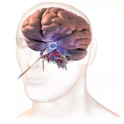 生长激素和泌乳素混合性垂体瘤,脑垂体瘤术后生长激素低怎么办